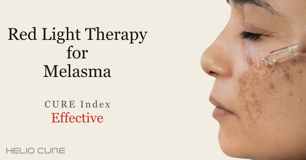 Red light therapy for melasma