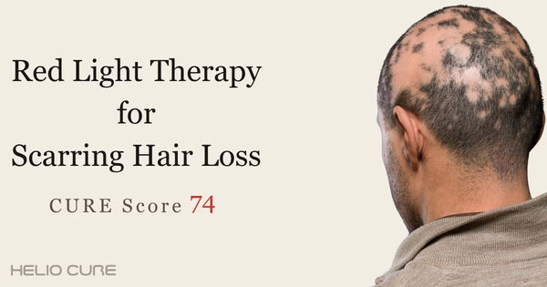 Red light therapy for scarring hair loss