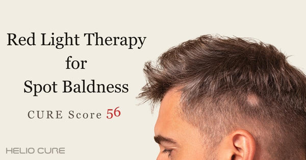 Red light therapy for spot baldness