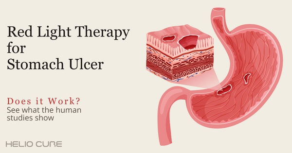 Red light therapy for stomach ulcer