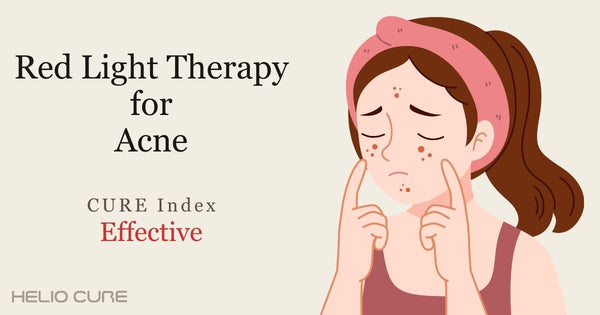 Red light therapy for acne