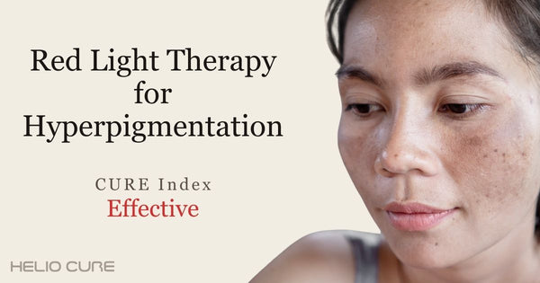 Red light therapy for hyperpigmentation