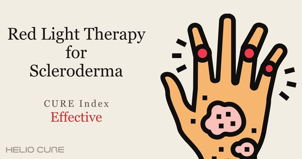 Red light therapy for scleroderma