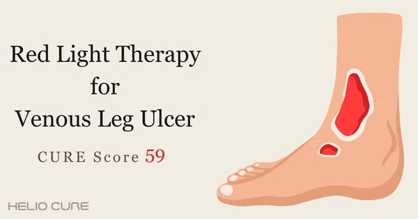 Red light therapy for venous leg ulcer